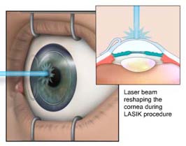 Lasik Surgery